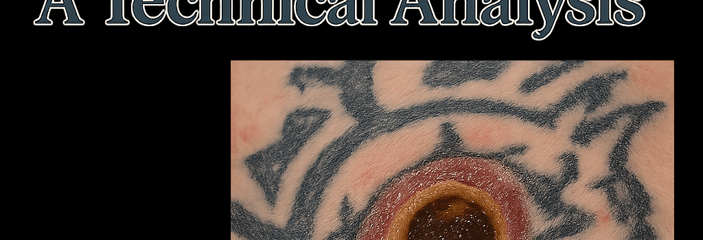 Tattoo-Associated Necrotic Ulceration: A Technical Analysis image
